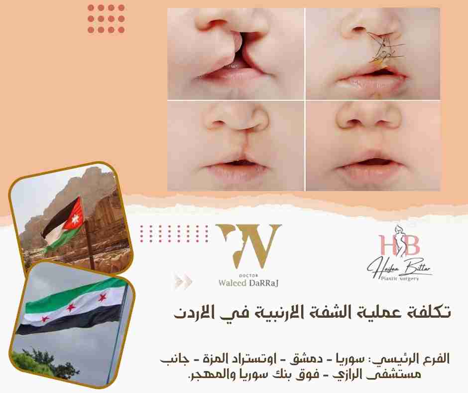 تكلفة عملية الشفة الارنبية في الاردن