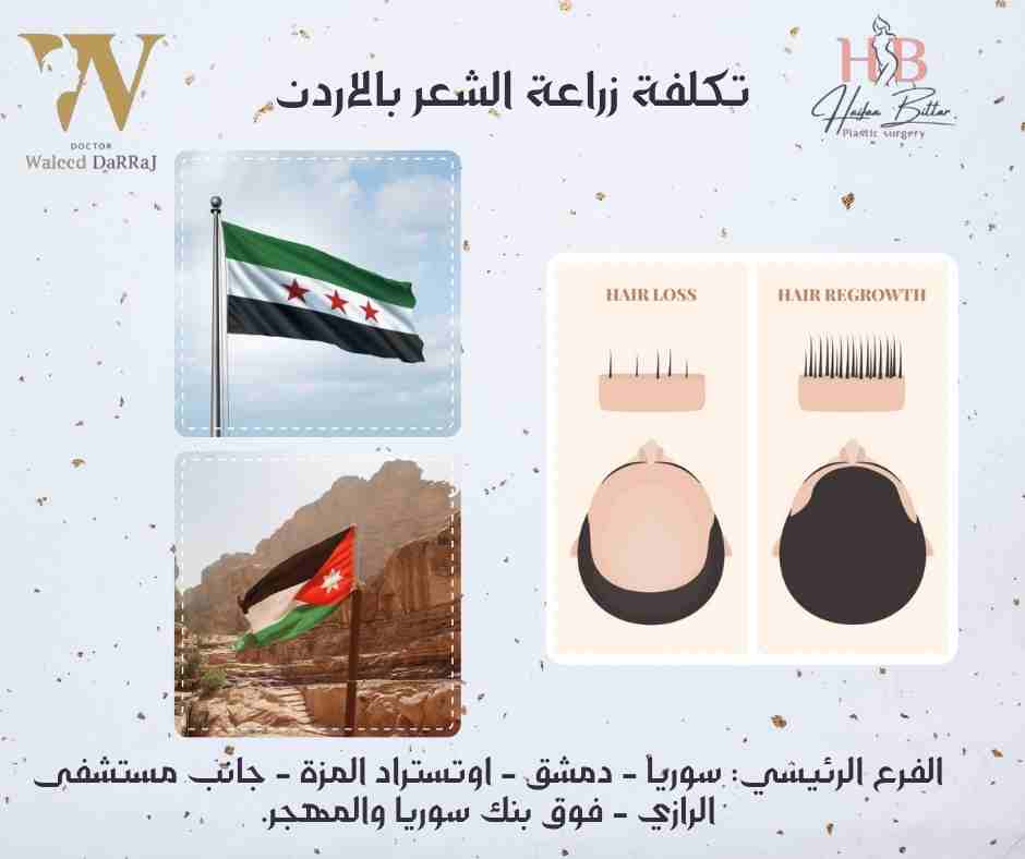 تكلفة زراعة الشعر بالاردن