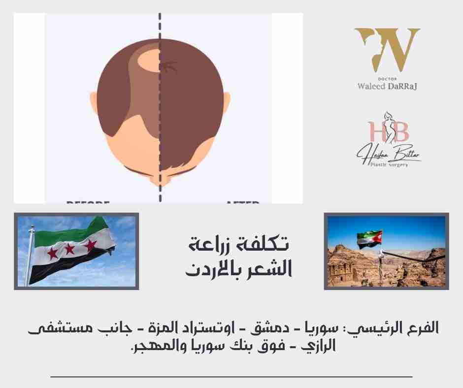 تكلفة زراعة الشعر بالاردن