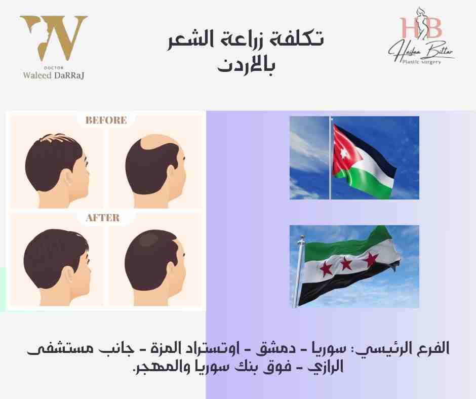 تكلفة زراعة الشعر بالاردن