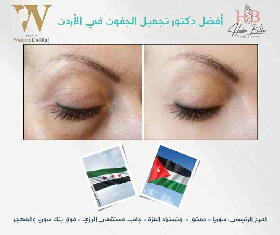 أفضل دكتور تجميل الجفون في الأردن