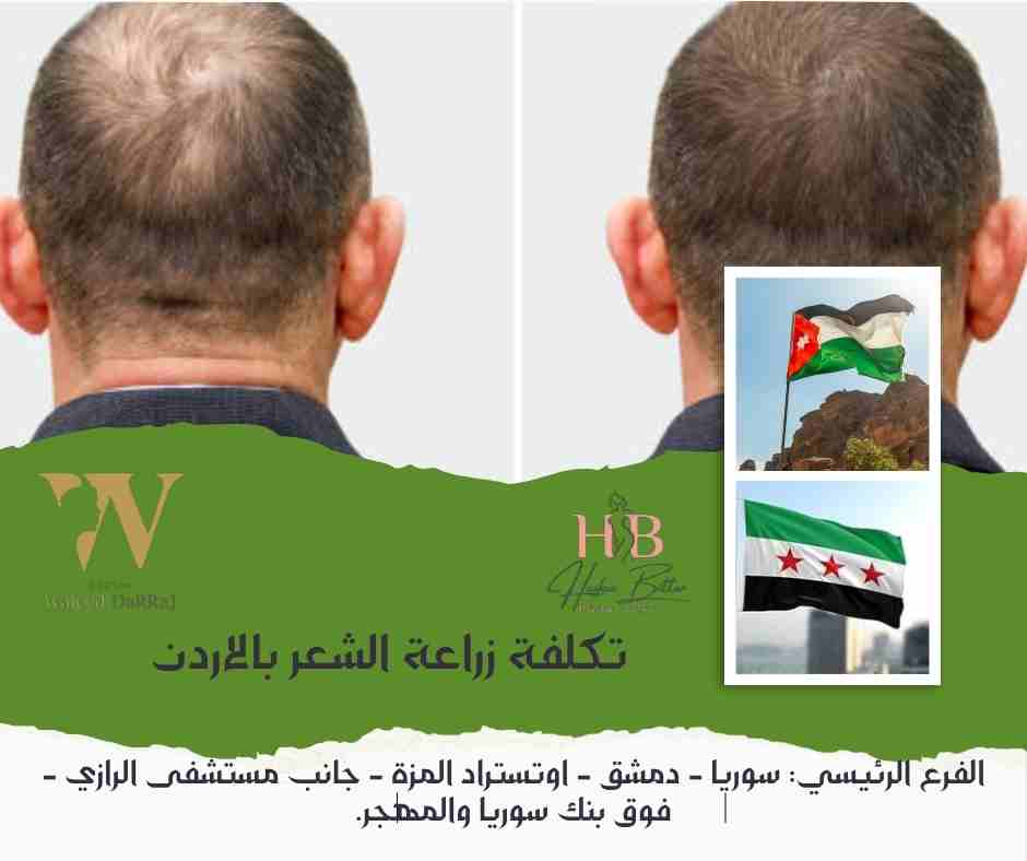 تكلفة زراعة الشعر بالاردن