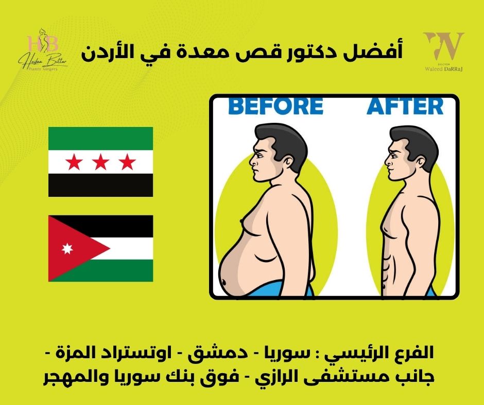 أفضل دكتور قص معدة في الأردن