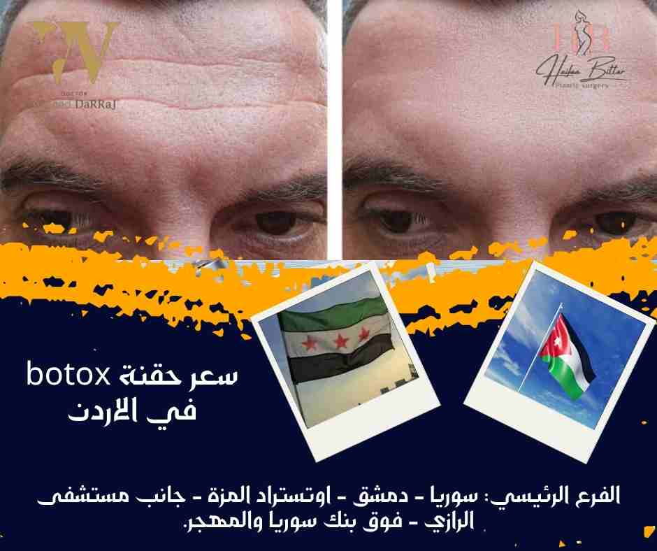 سعر حقنة botox في الاردن