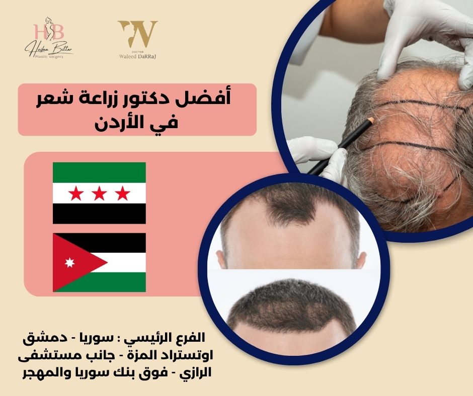 أفضل مركز زراعة شعر في الأردن