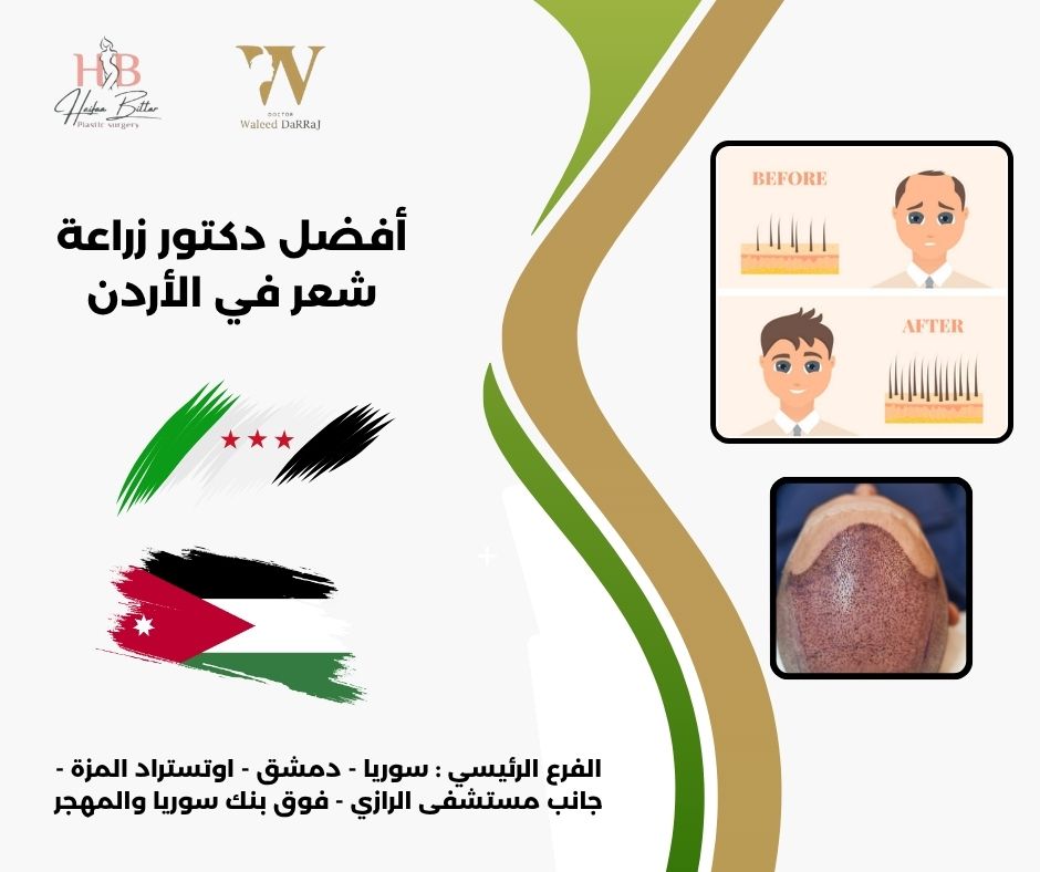 أفضل دكتور زراعة شعر في الأردن