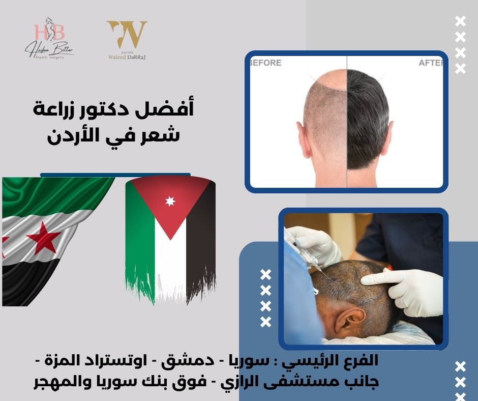 افضل مركز زراعة شعر في الاردن
