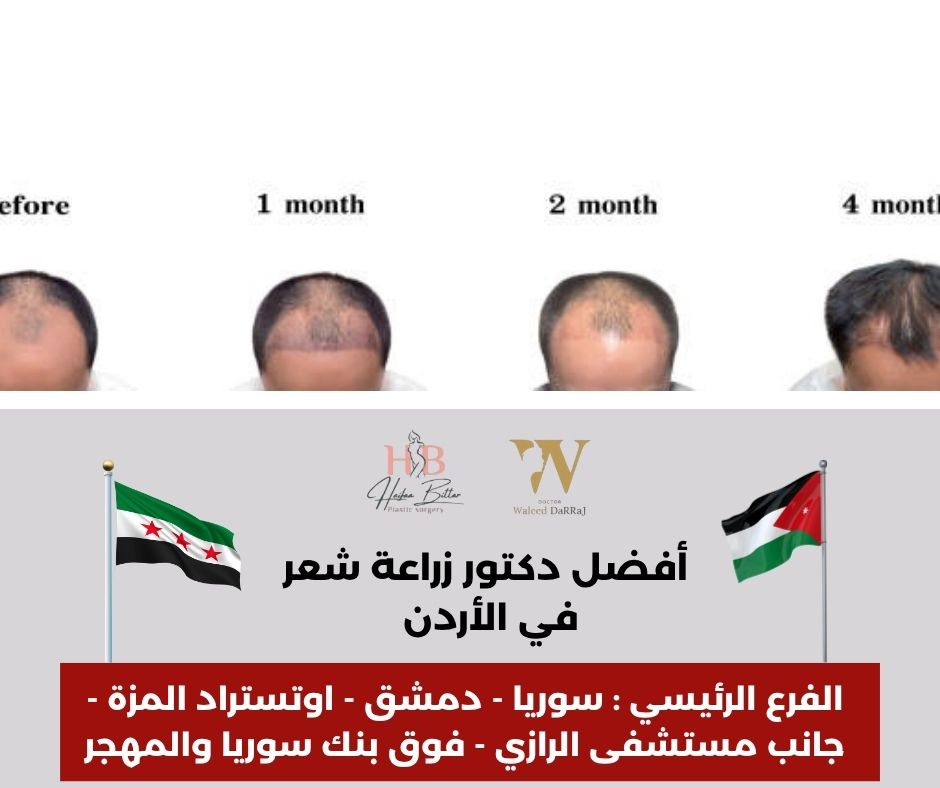 افضل دكتور لزراعة الشعر في الاردن