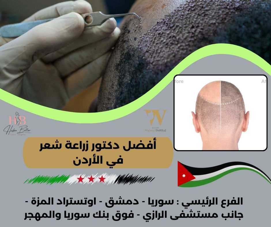 أفضل مركز زراعة شعر في الأردن