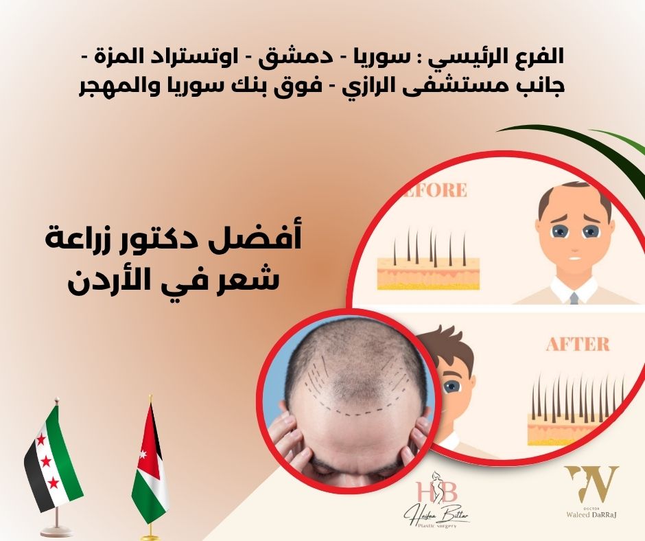 افضل دكتور زراعة شعر في الاردن