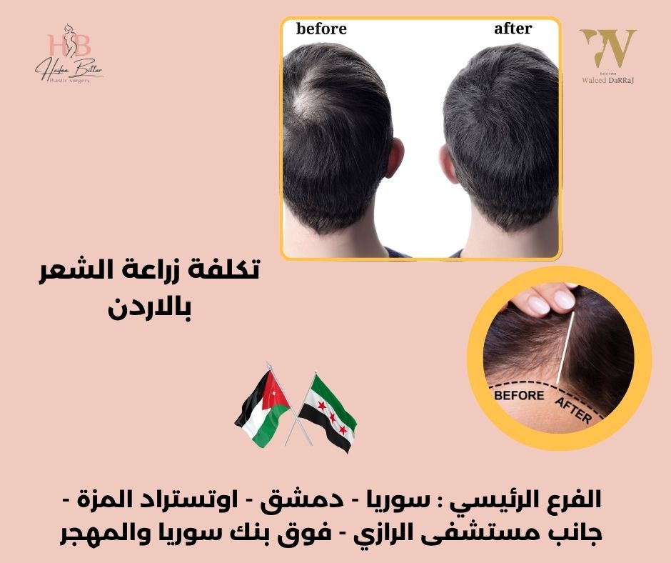 تجارب زراعة الشعر في الأردن