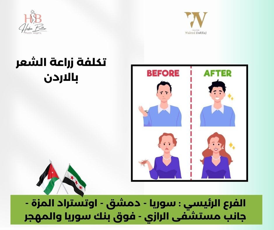 تكلفة زراعة الشعر بالاردن