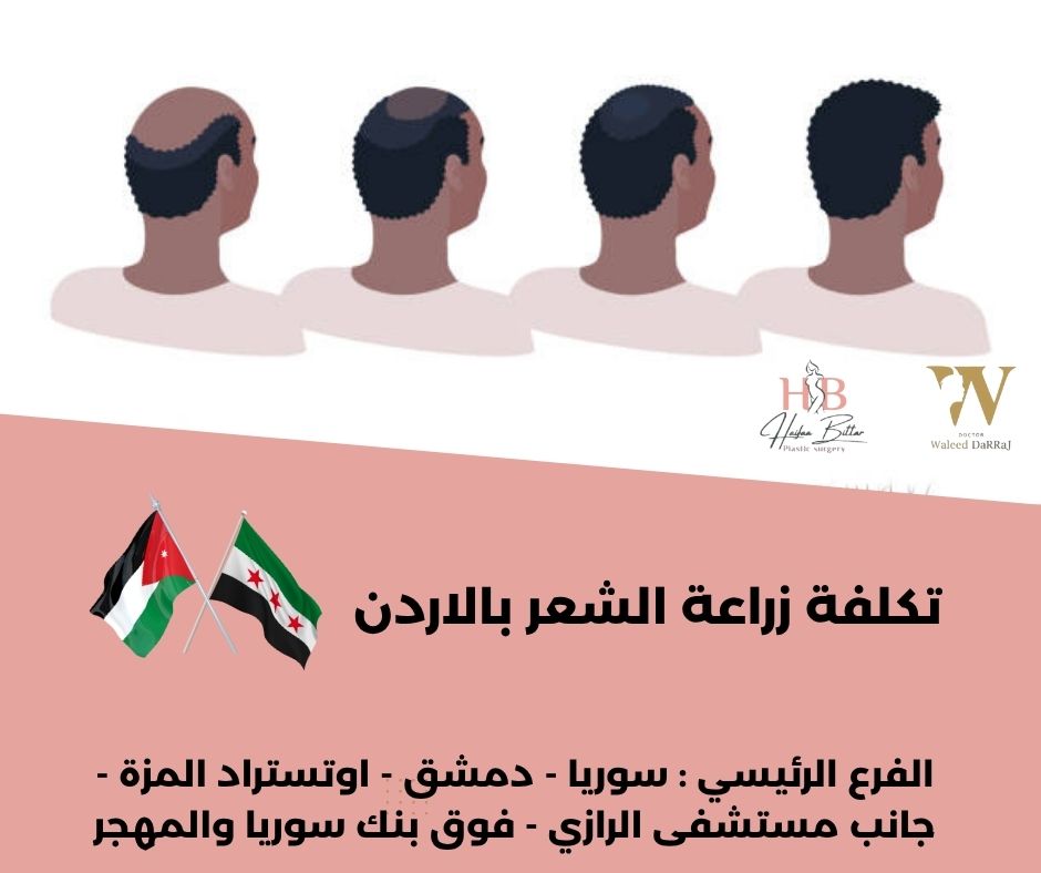 زراعة الشعر في الأردن أقساط