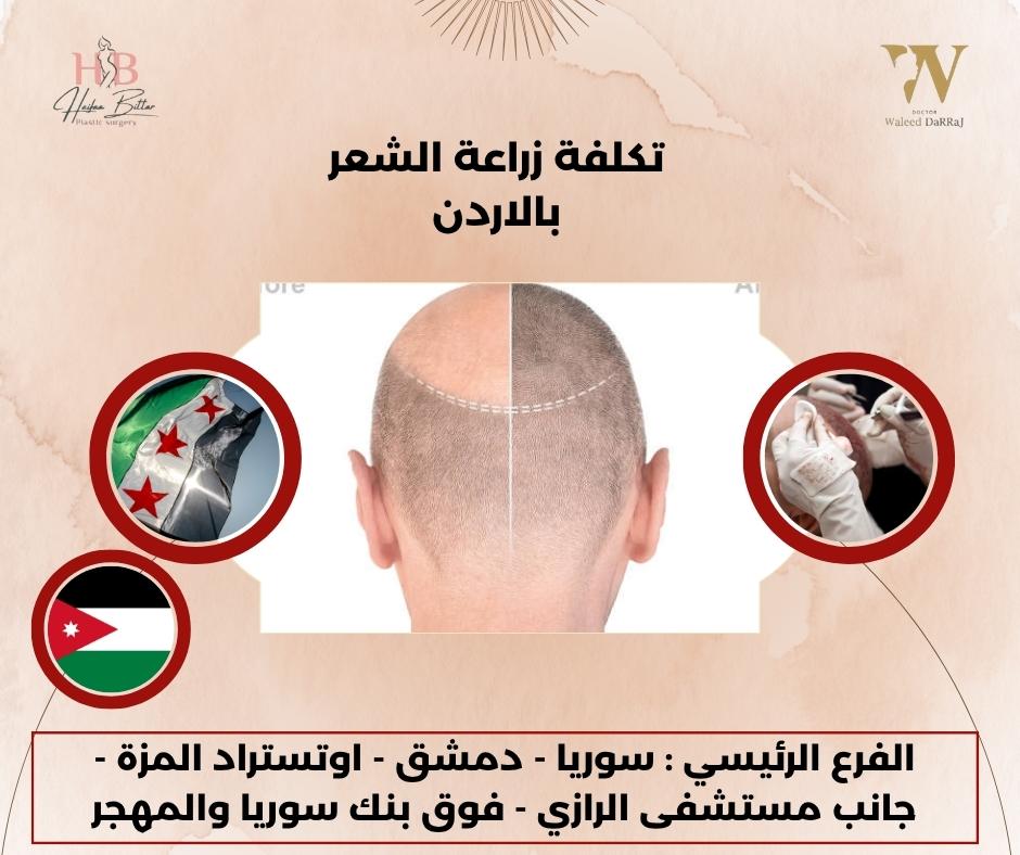 هل ممكن أزرع لحية أو حواجب بنفس التقنية؟