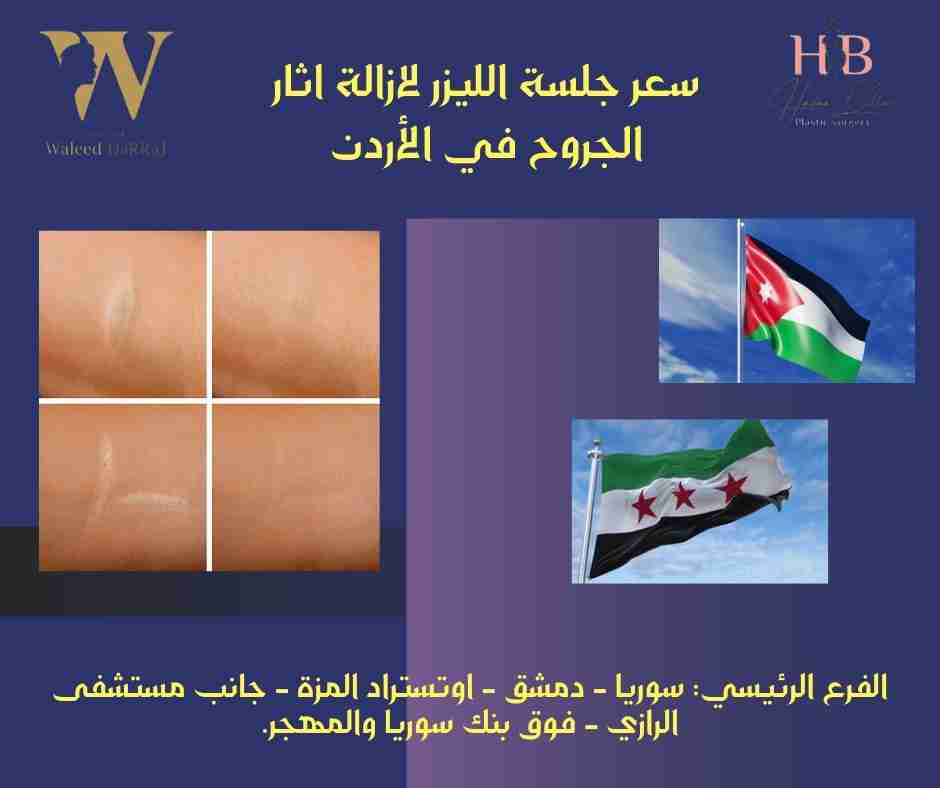 سعر جلسة الليزر لازالة اثار الجروح في الأردن