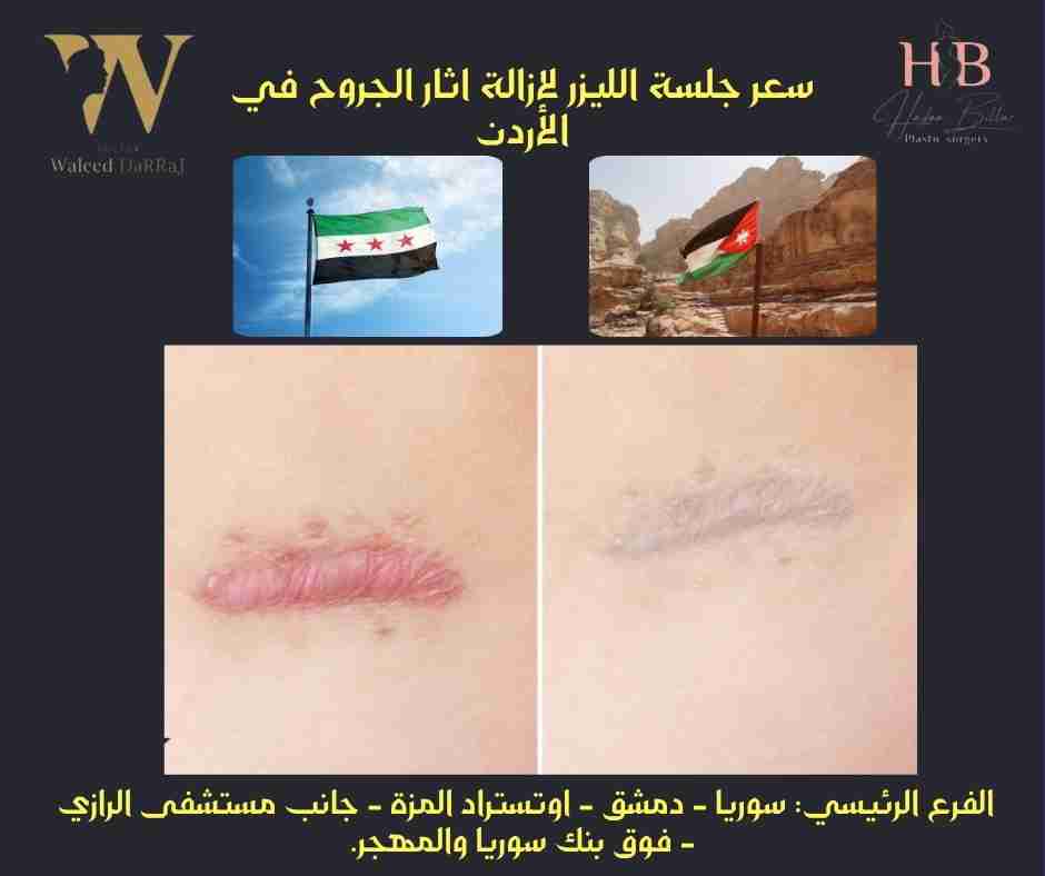 سعر جلسة الليزر لازالة اثار الجروح في الأردن