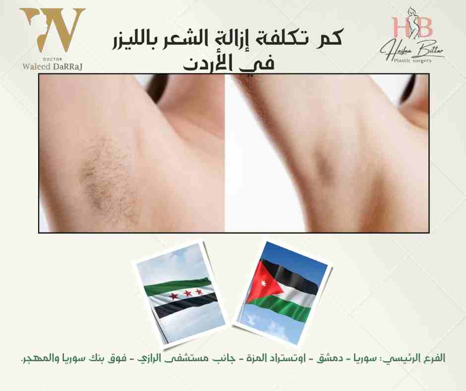 كم تكلفة إزالة الشعر بالليزر في الأردن