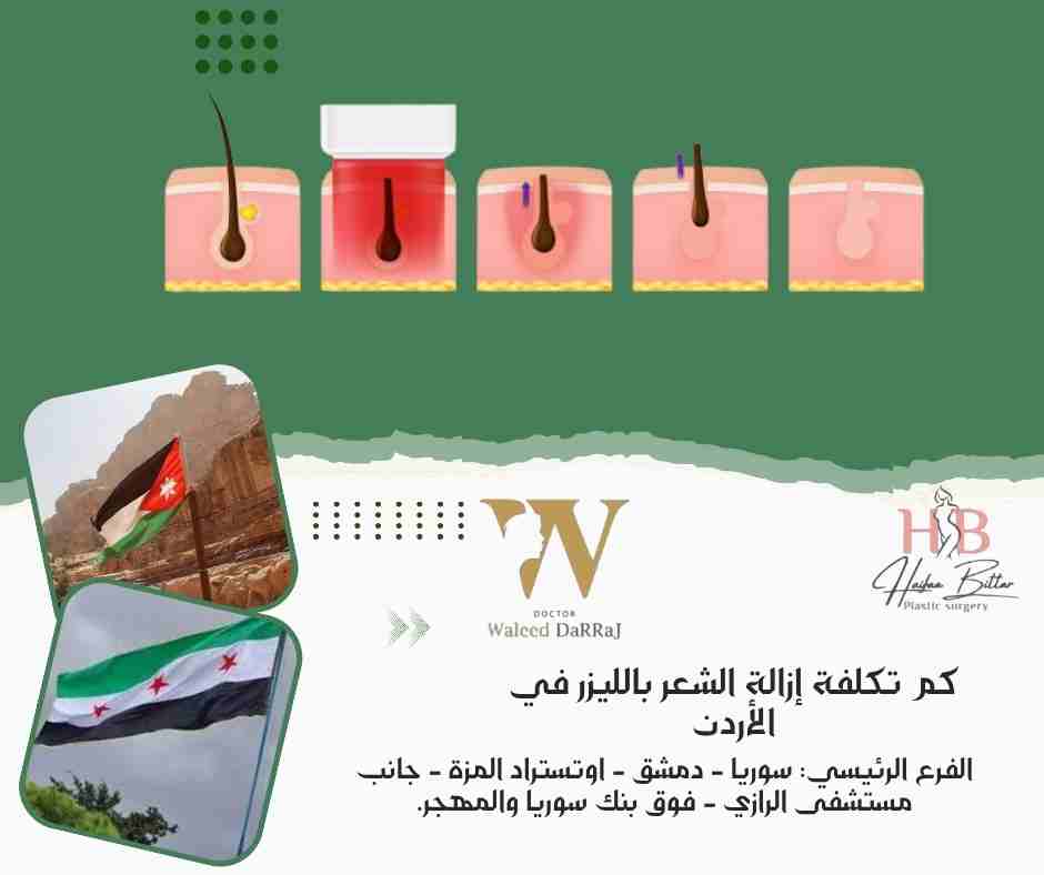 كم تكلفة إزالة الشعر بالليزر في الأردن