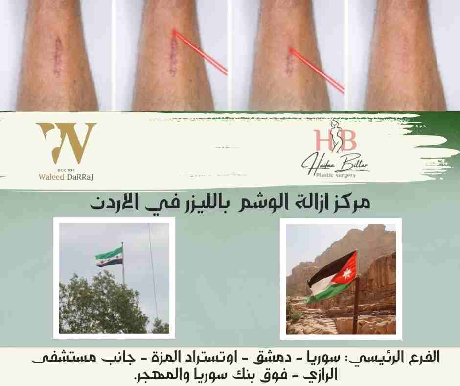 مركز ازالة الوشم بالليزر في الاردن