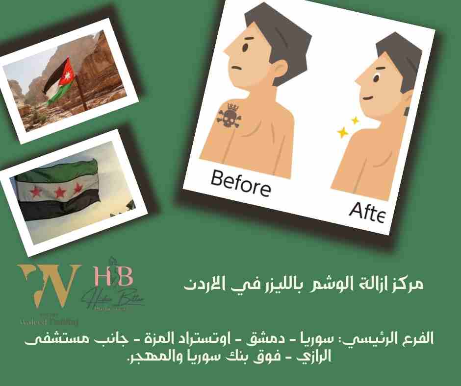 مركز ازالة الوشم بالليزر في الاردن