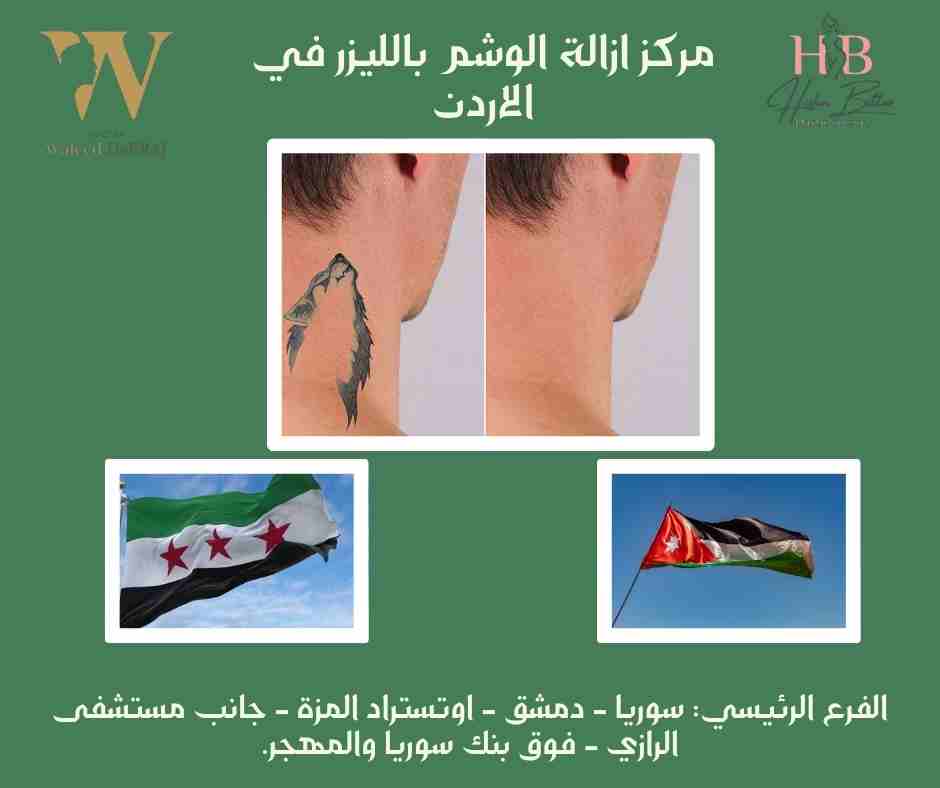 مركز ازالة الوشم بالليزر في الاردن