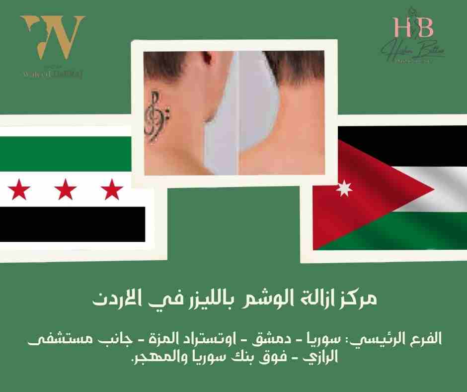 مركز ازالة الوشم بالليزر في الاردن