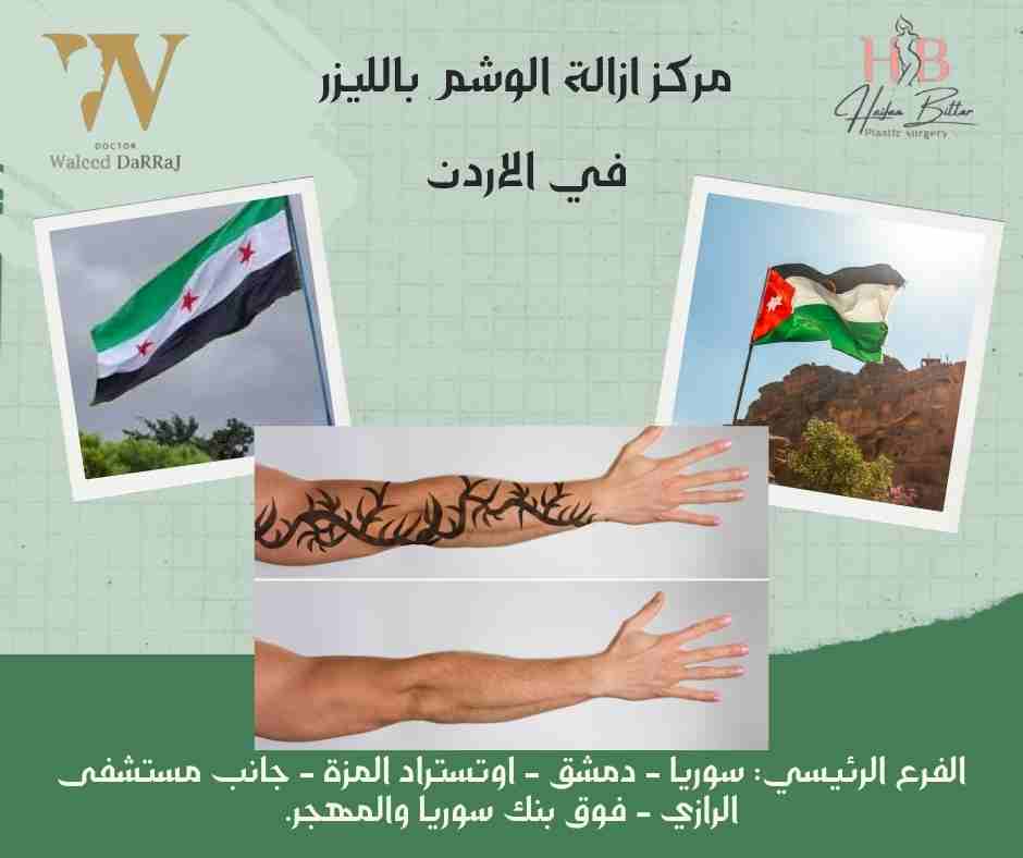 مركز ازالة الوشم بالليزر في الاردن