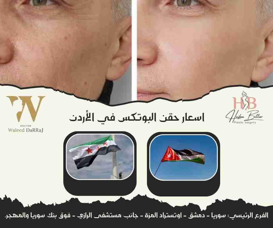 اسعار حقن البوتكس في الأردن
