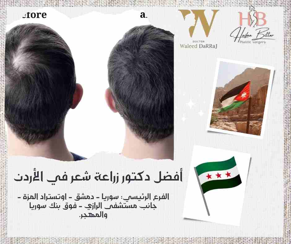أفضل دكتور زراعة شعر في الأردن