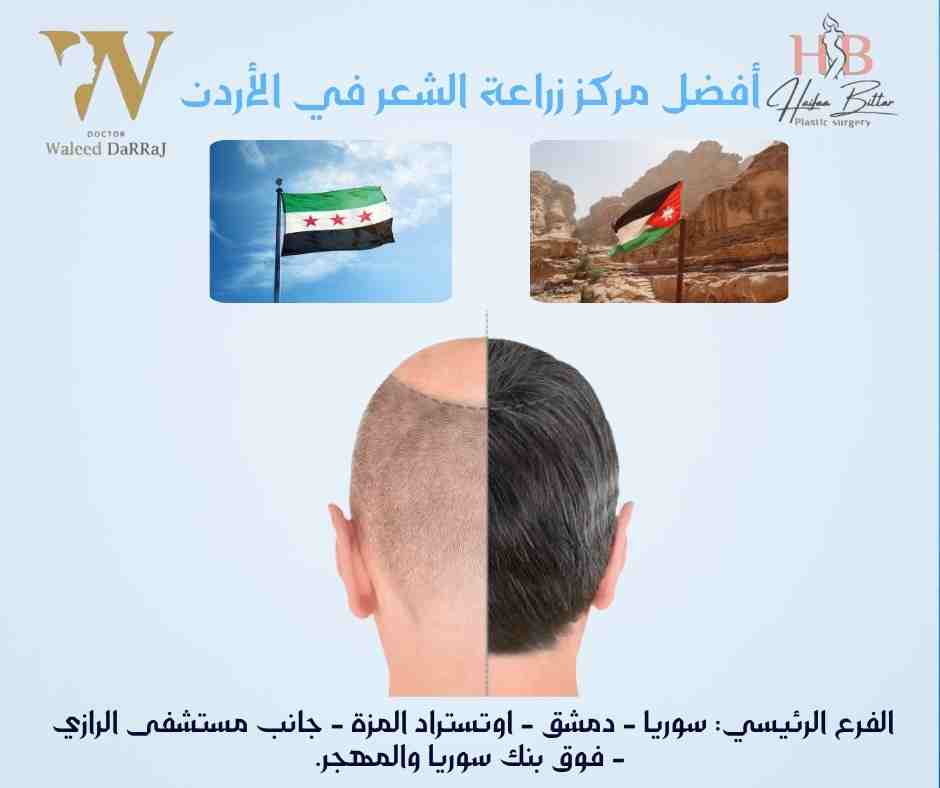 أفضل مركز زراعة الشعر في الأردن