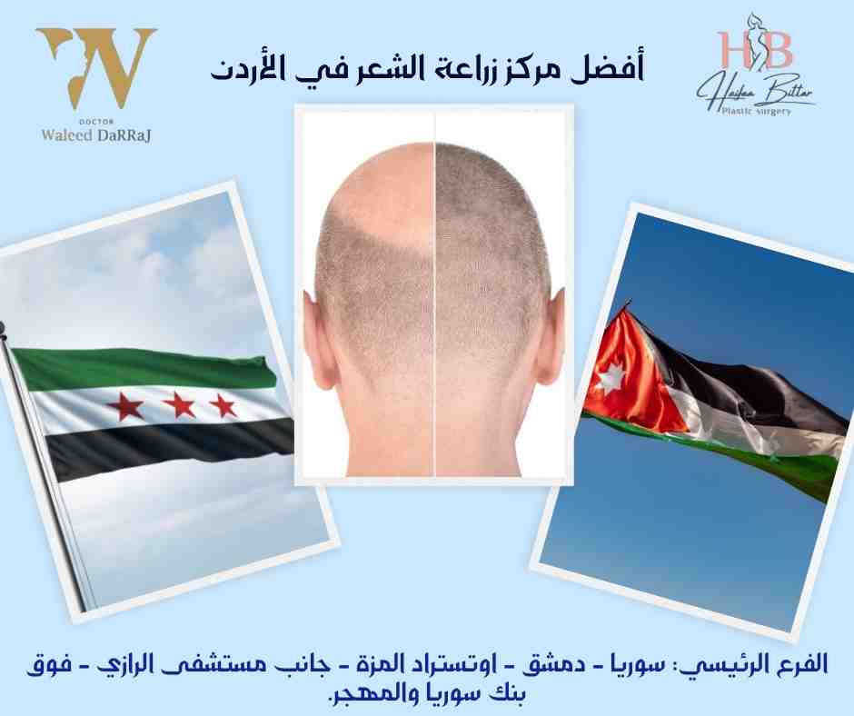 أفضل مركز زراعة الشعر في الأردن