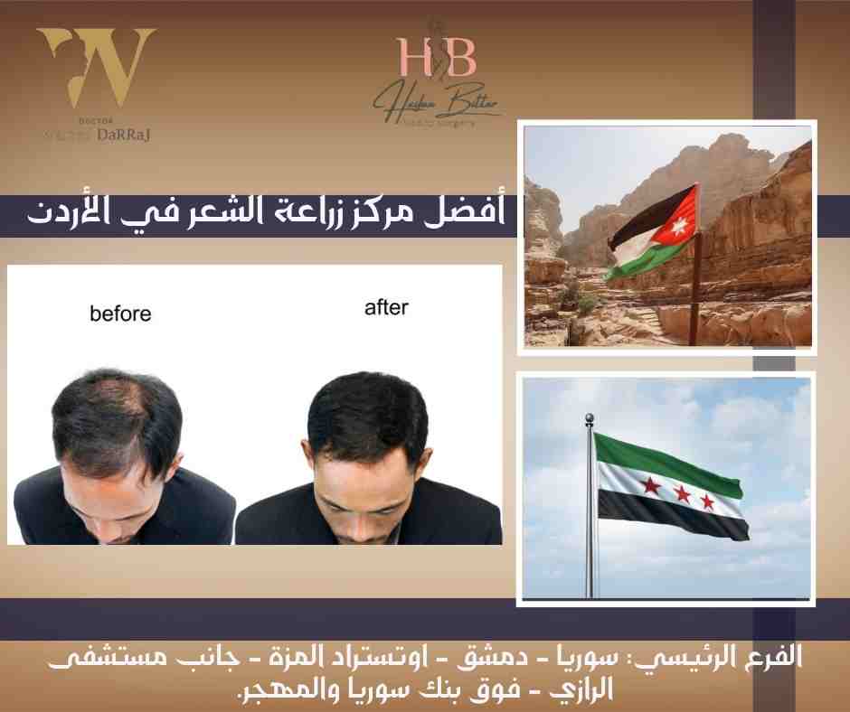 أفضل مركز زراعة الشعر في الأردن