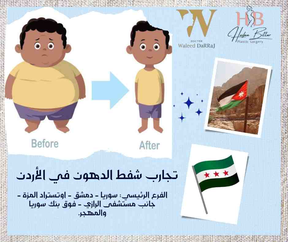 تجارب شفط الدهون في الأردن