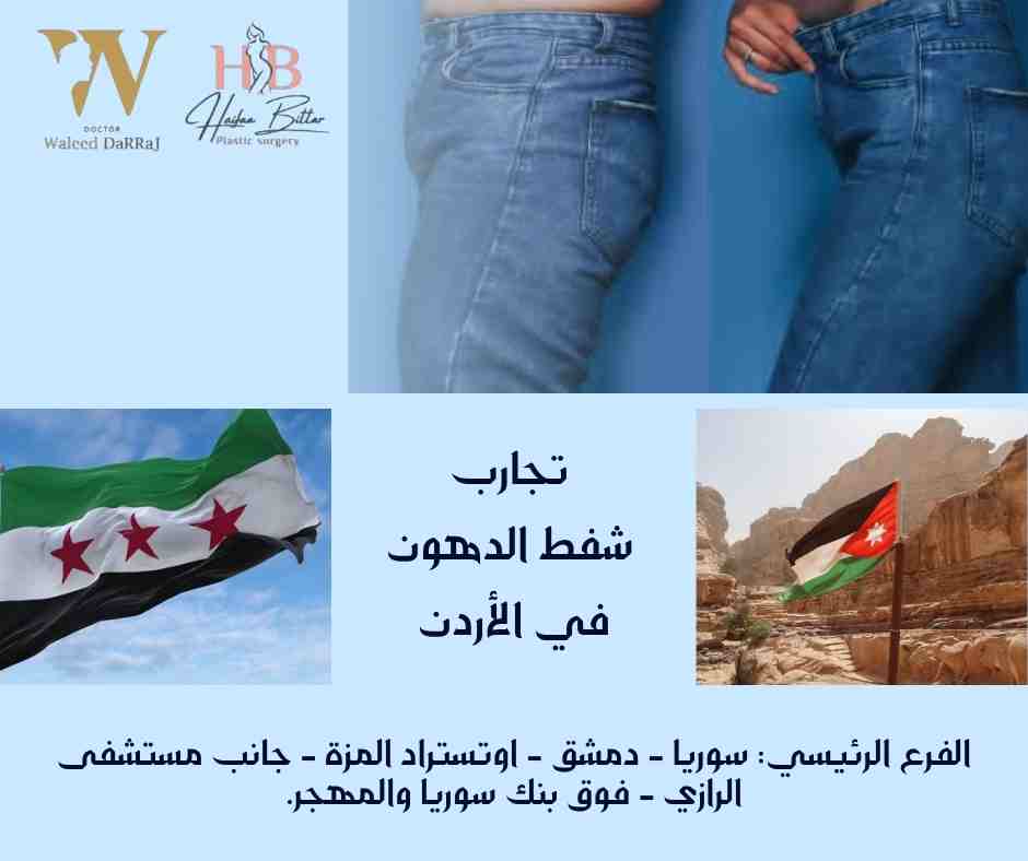تجارب شفط الدهون في الأردن