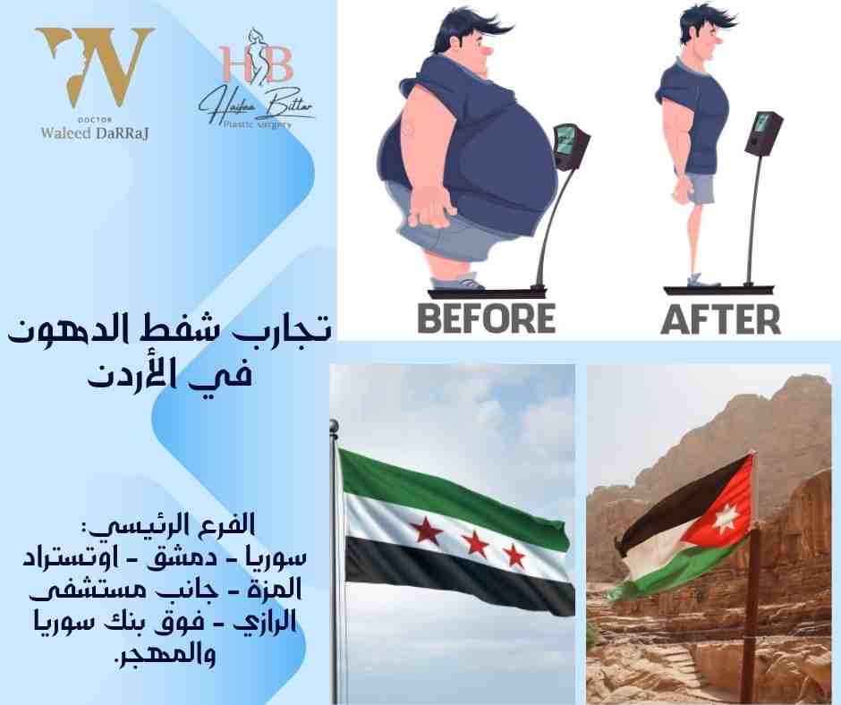 تجارب شفط الدهون في الأردن