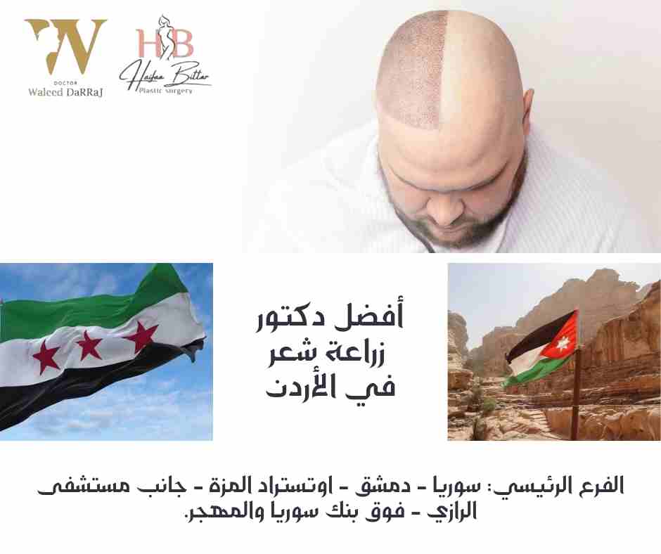 أفضل دكتور زراعة شعر في الأردن