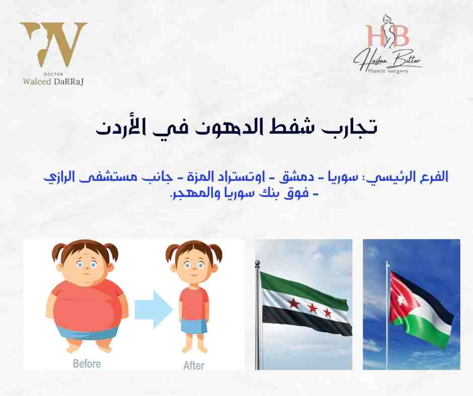 تجارب شفط الدهون في الأردن