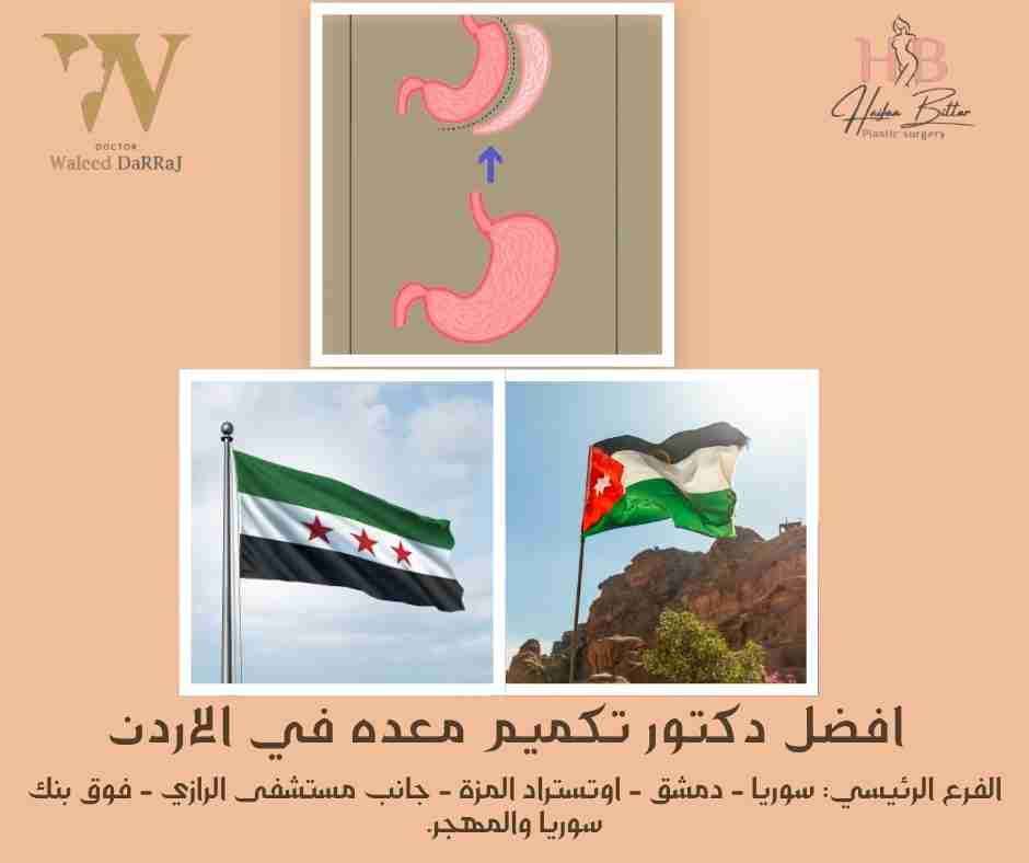 افضل دكتور تكميم معده في الاردن