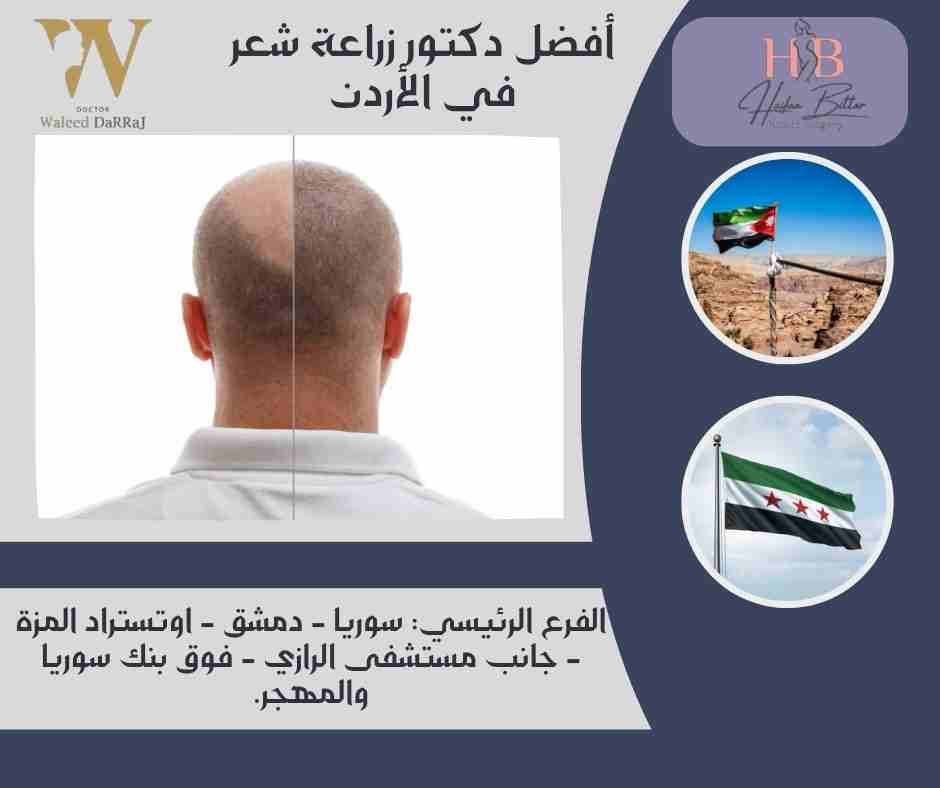 أفضل دكتور زراعة شعر في الأردن