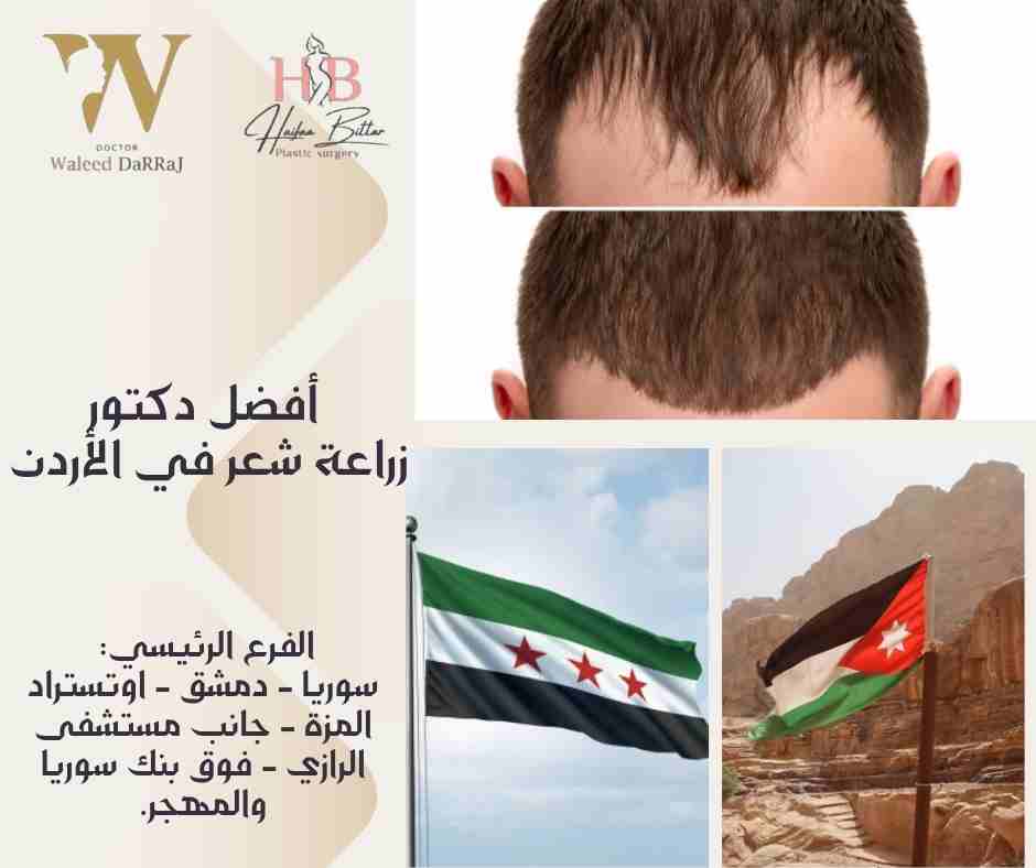 أفضل دكتور زراعة شعر في الأردن