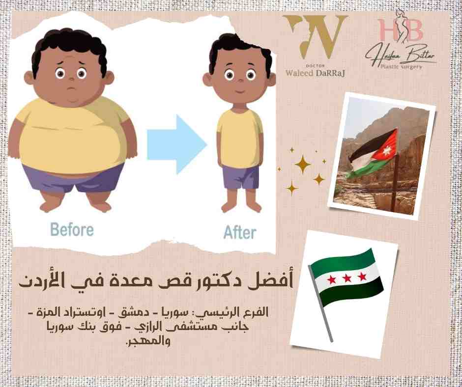 أفضل دكتور قص معدة في الأردن