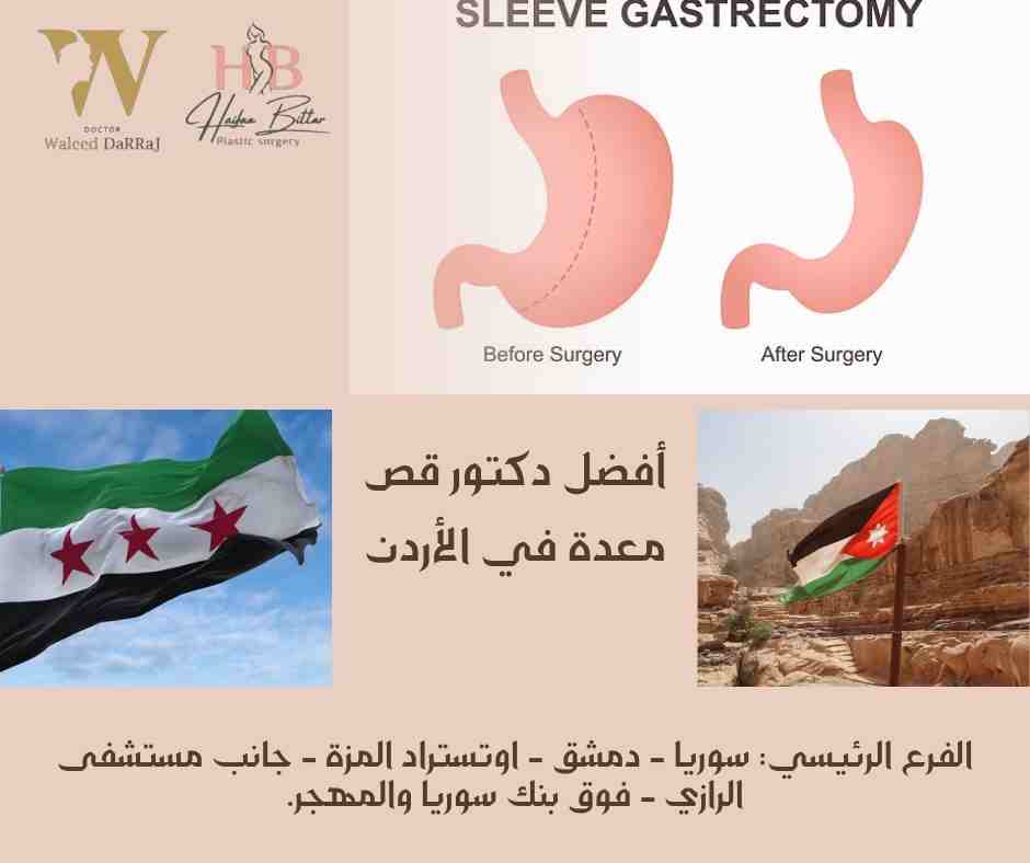 أفضل دكتور قص معدة في الأردن