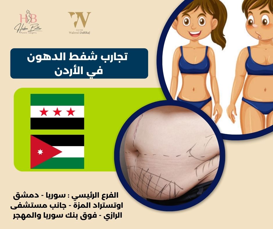 تجارب شفط الدهون في الأردن