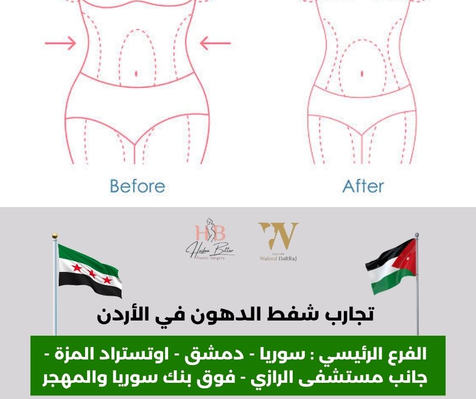 تكلفة شفط الدهون في الاردن