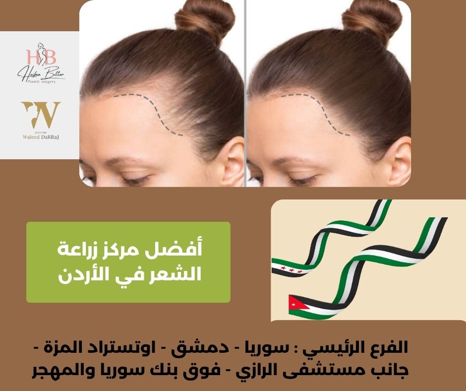 افضل مركز زراعة الشعر في الاردن
