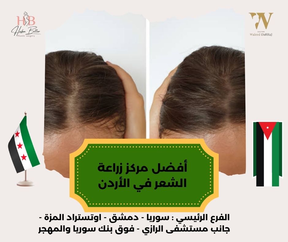 أفضل مركز زراعة الشعر في الأردن