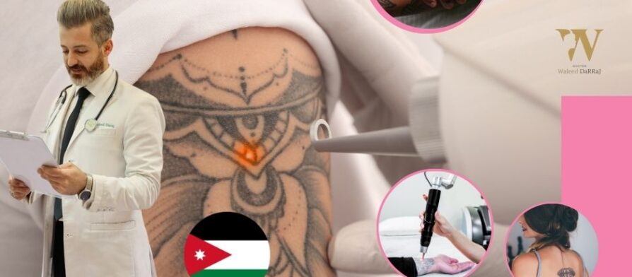 مركز ازالة الوشم بالليزر في الاردن