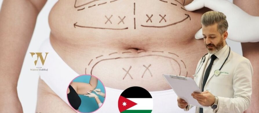 تجارب شفط الدهون في الأردن