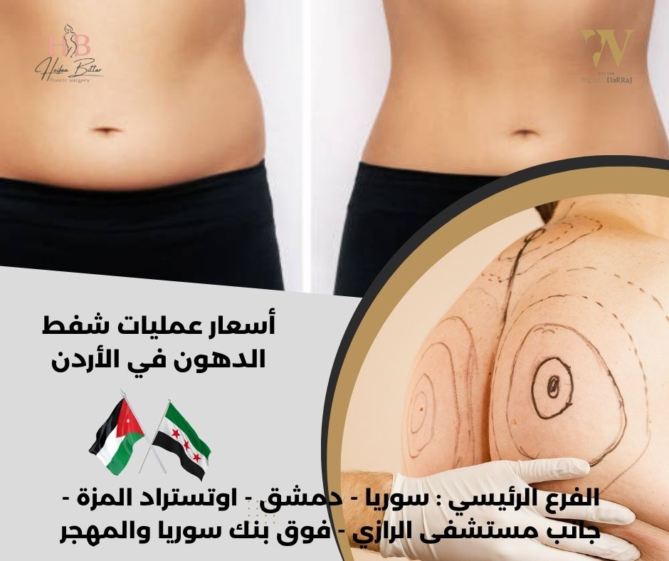 اسعار شفط الدهون في الاردن اسعار شفط الدهون في الاردن