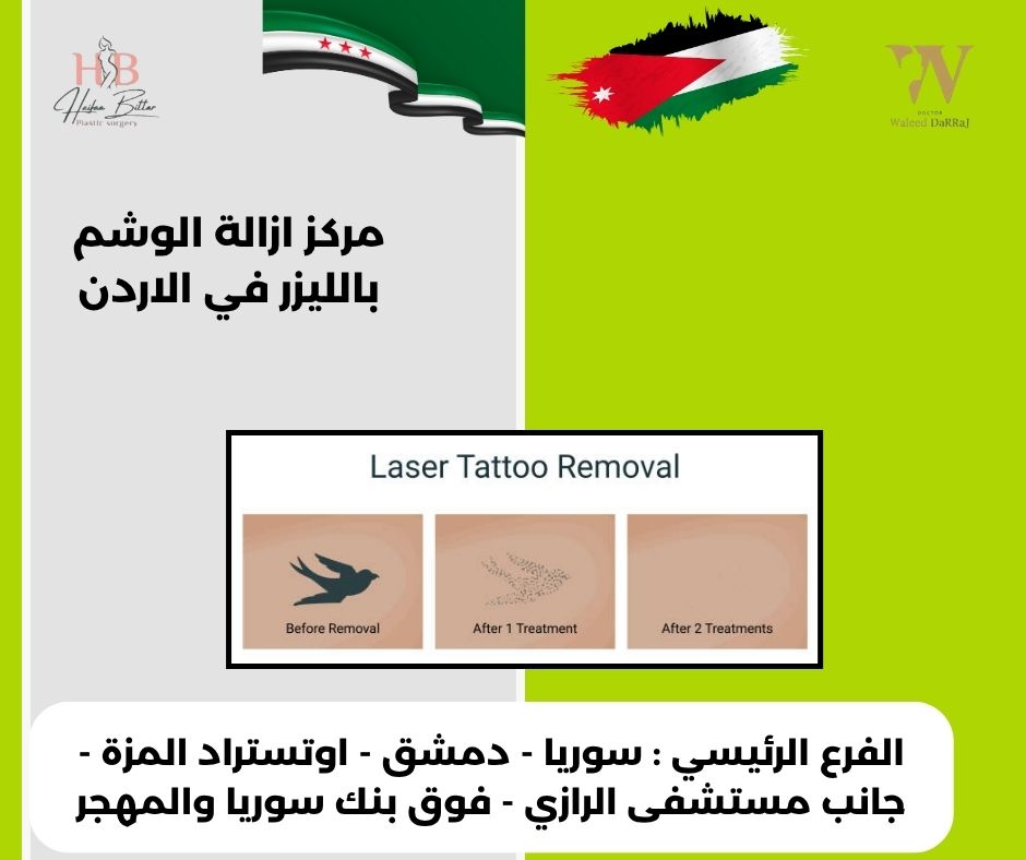 مركز ازالة الوشم بالليزر في الاردن